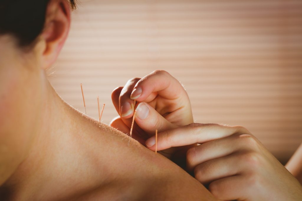 Acupuncture needles are incredibly thin, and many people can't even feel them.